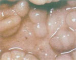 Гранулематозный колит (болезнь Крона)
